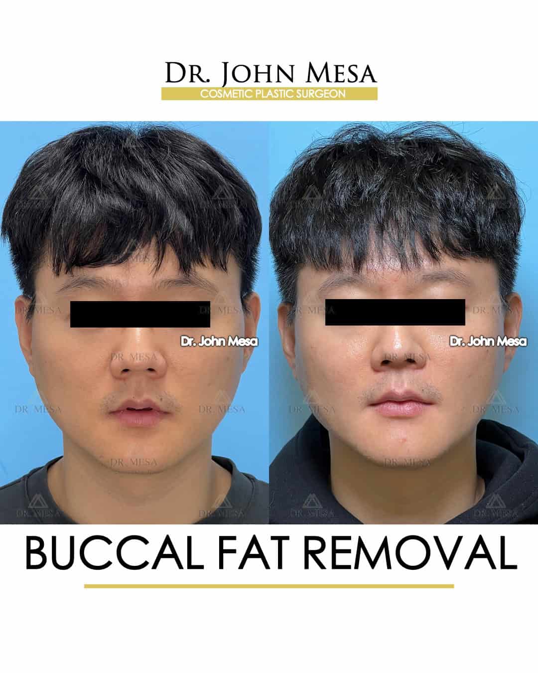 buccal fat removal surgery in asian men