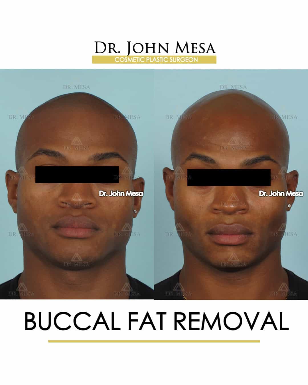 buccal fat removal before and after celebrities
