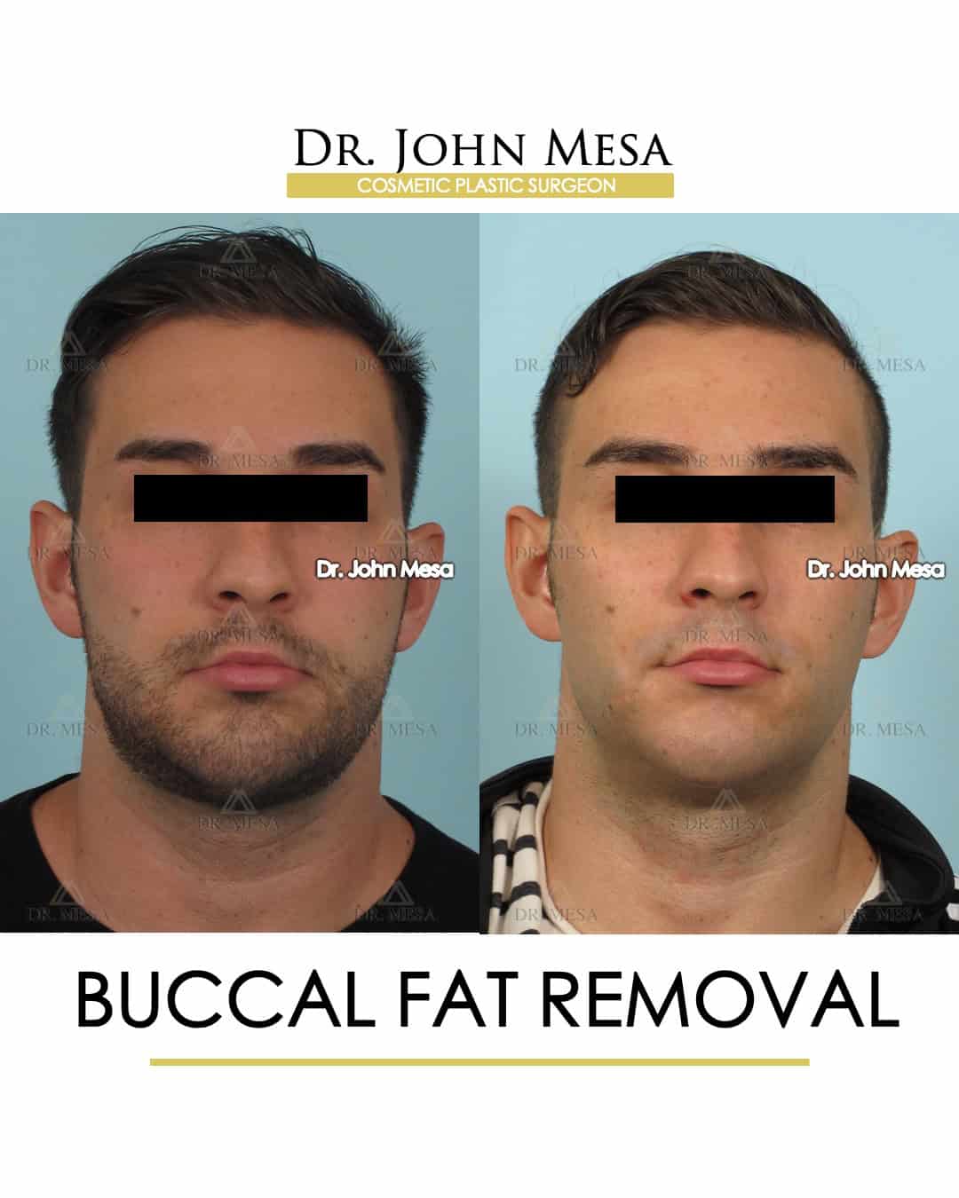 does buccal fat removal have long lasting effect?