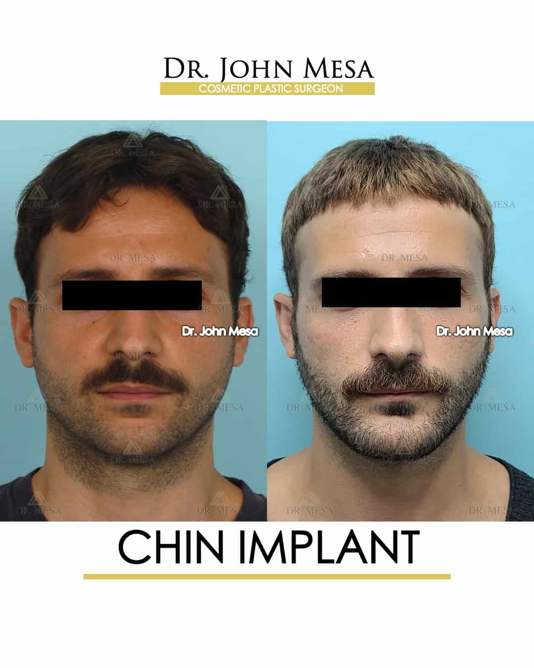 chin implant for men cost