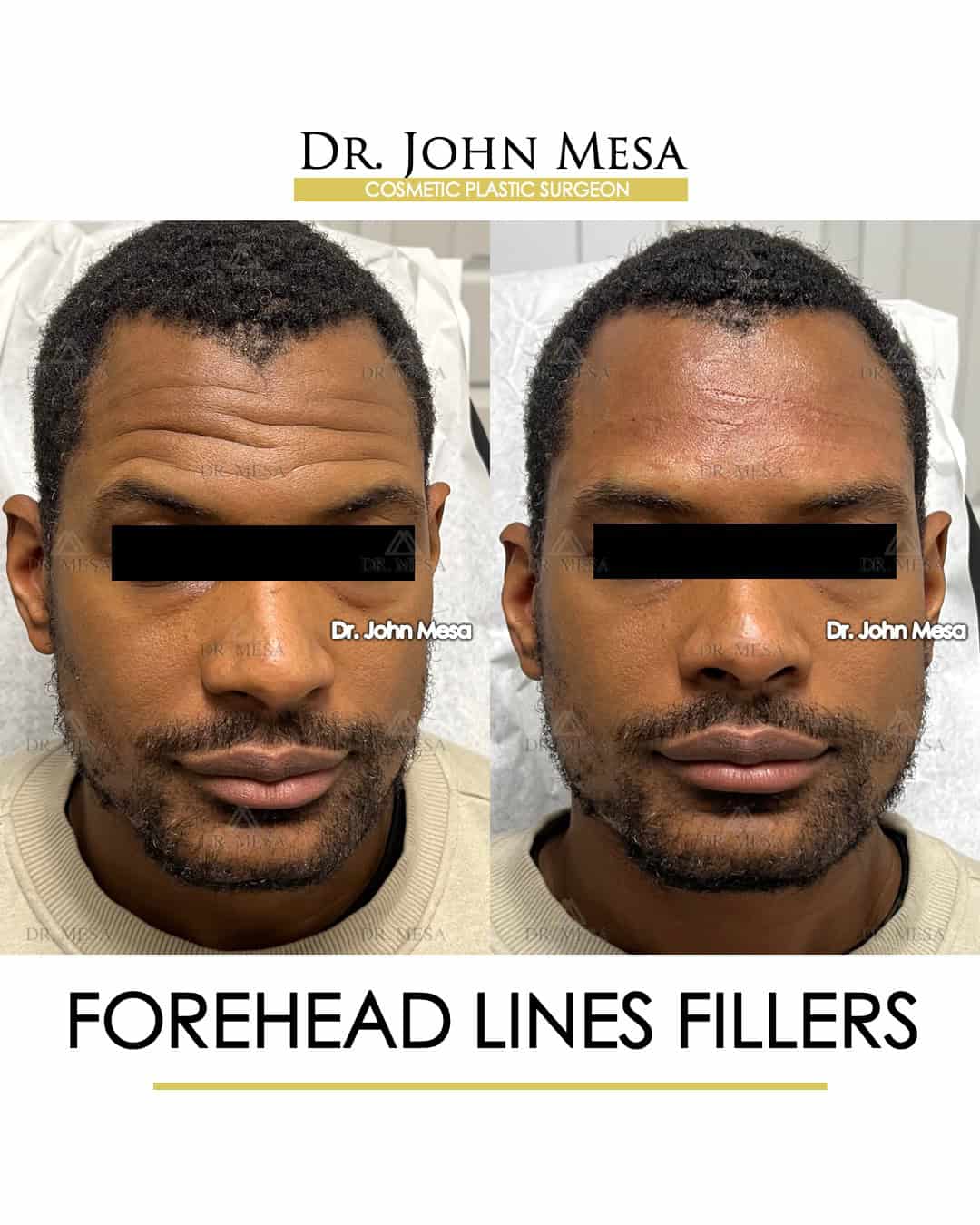 how to remove forehead lines