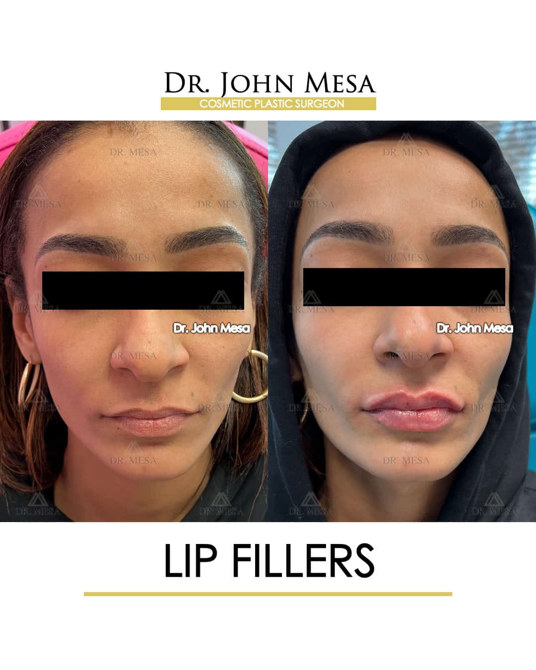 lip-fillers-cost-in-nyc
