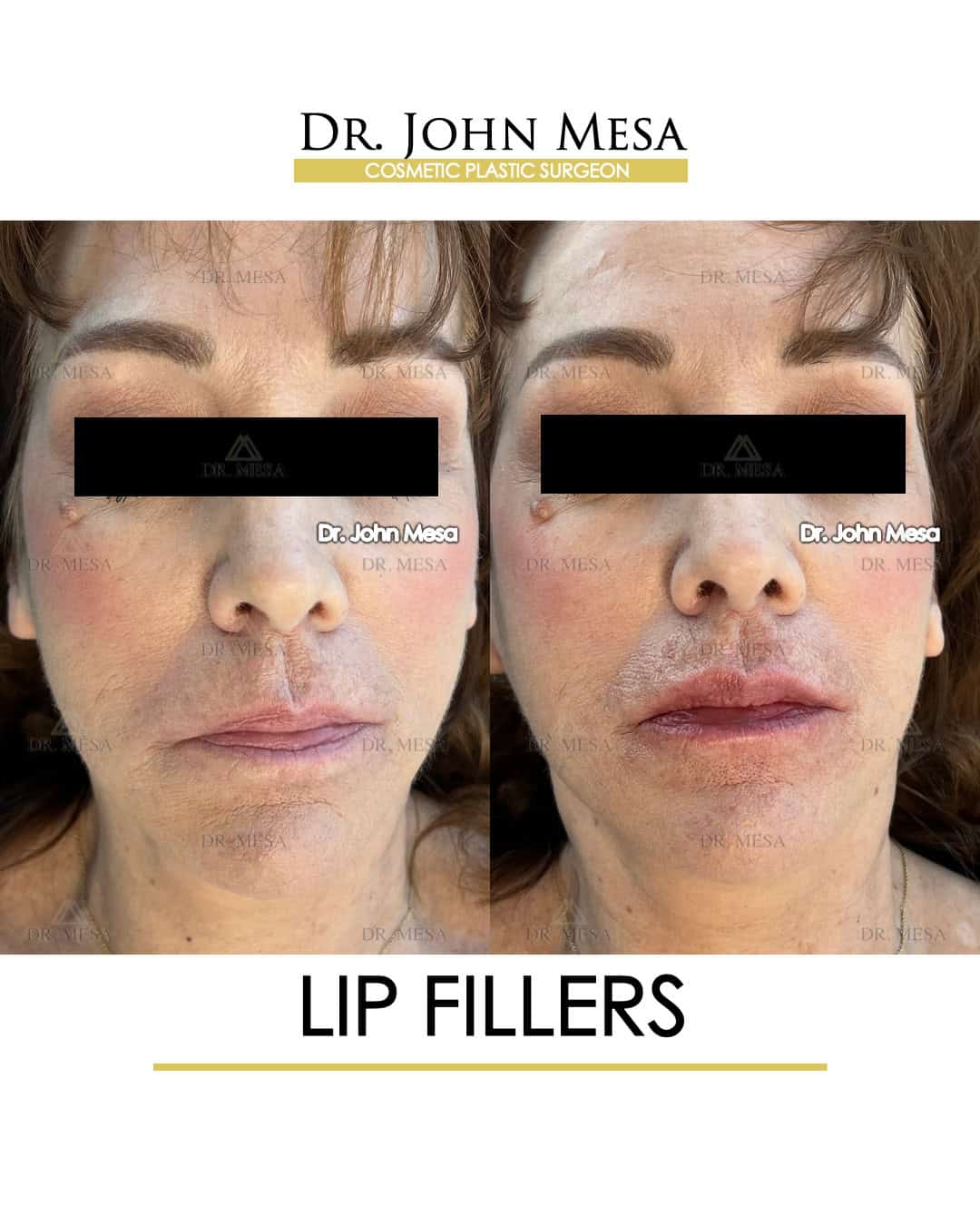 how-much-are-lip-fillers-in-nyc