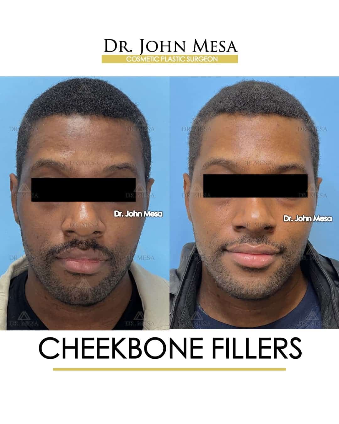 cheek implants before and after