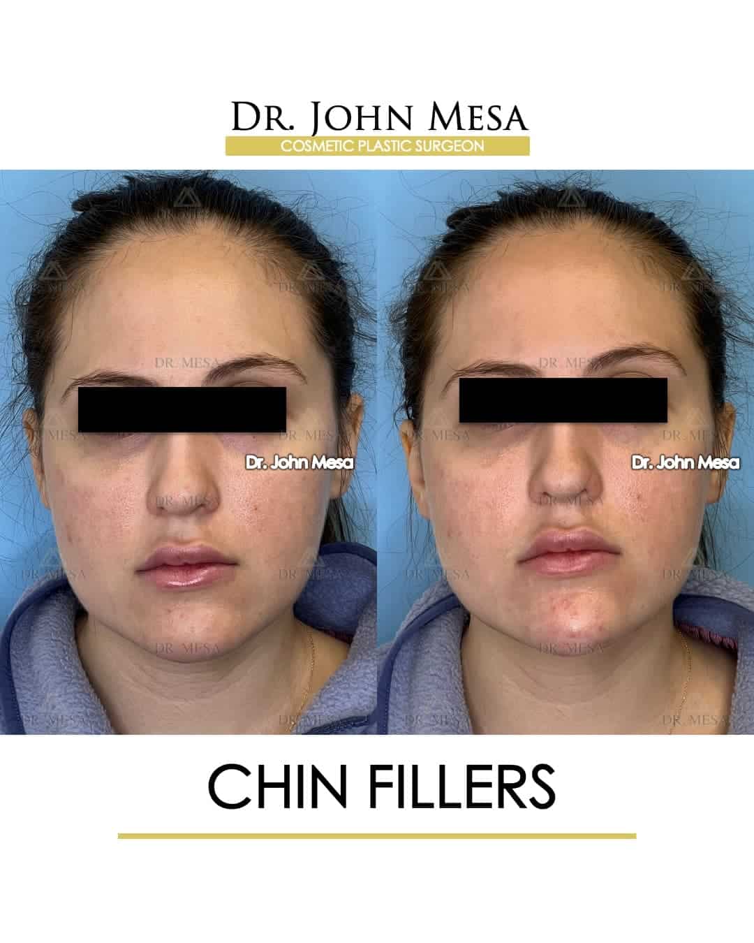 top doctor for chin fillers near me