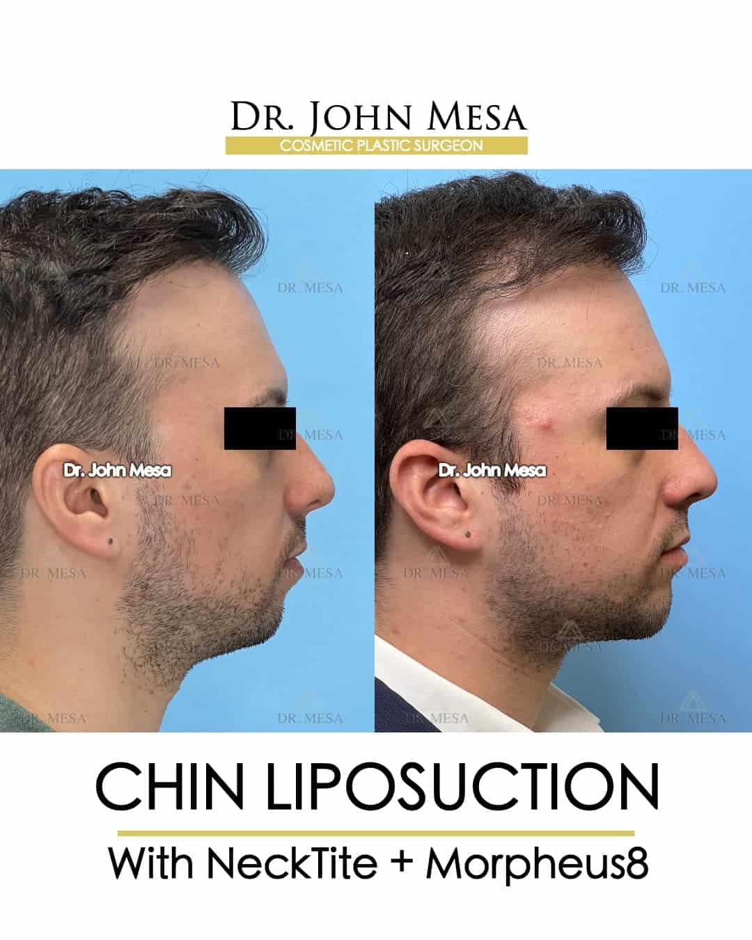 chin liposuction dos and donts after surgery