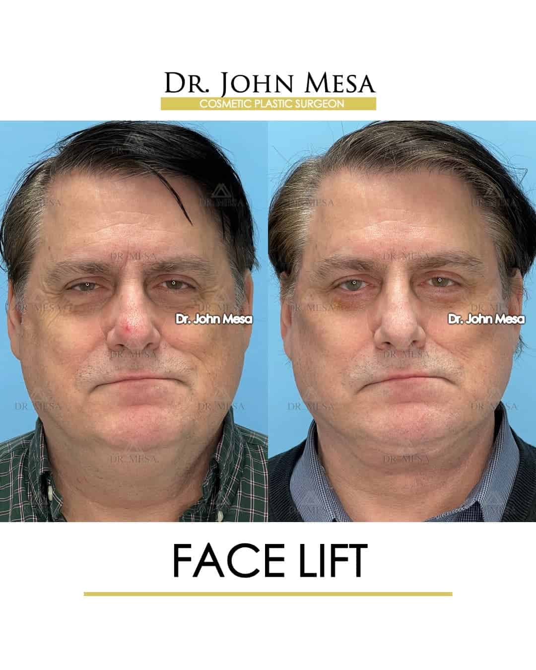 how to be a candidate for face lift in men