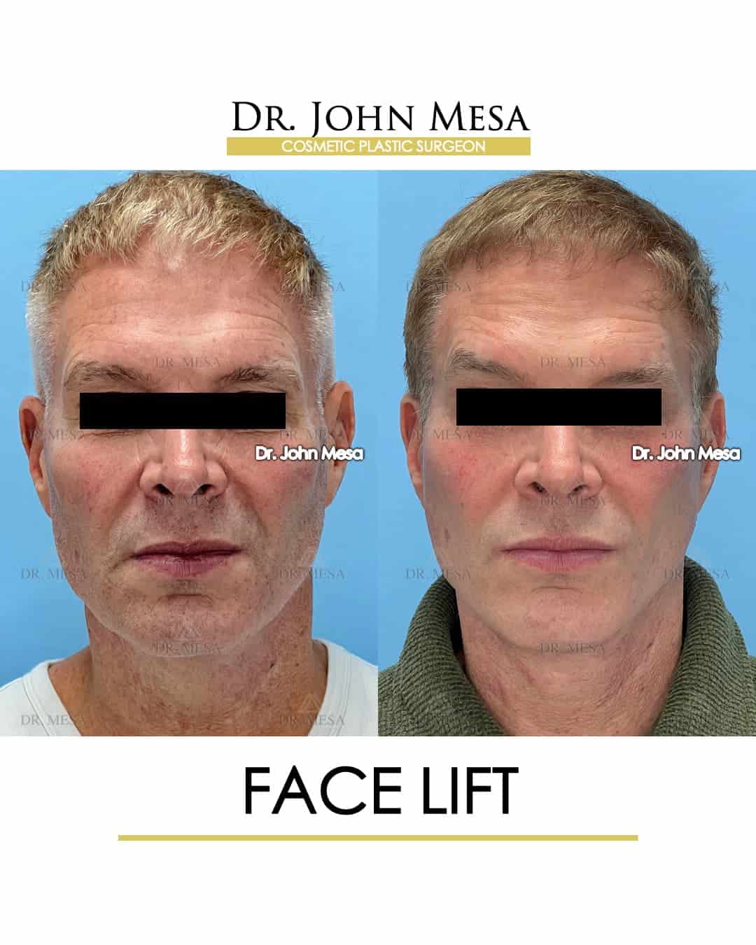 face lift scar recovery time