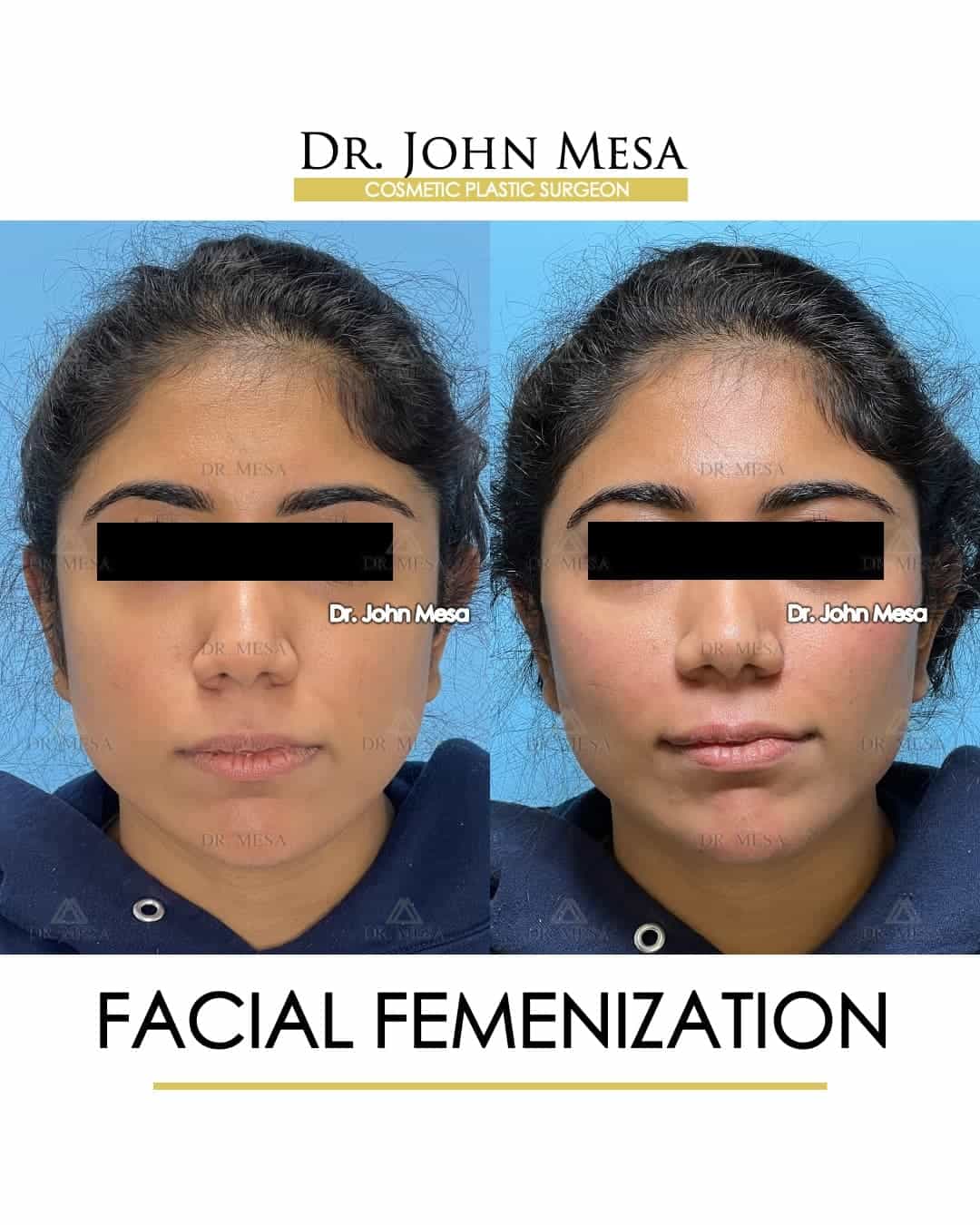 ffs facial feminization surgery price
