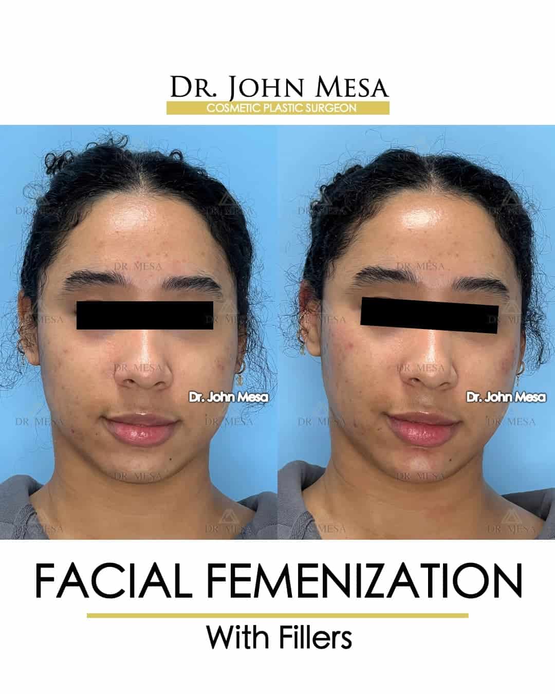 facial feminization surgery ffs before and after sample photos