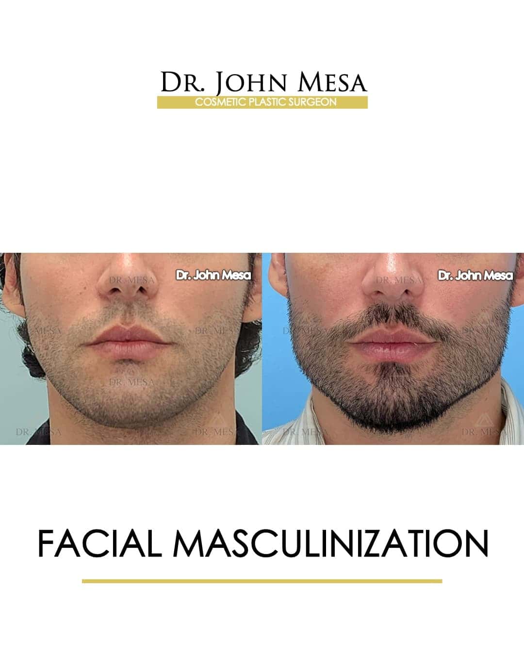 facial masculinization surgery doctor near me