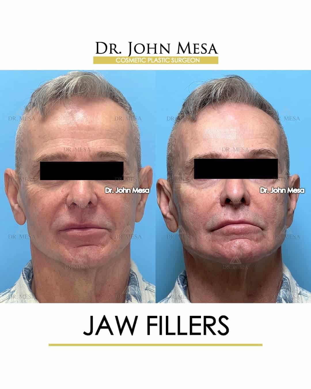 is jaw fillers expensive