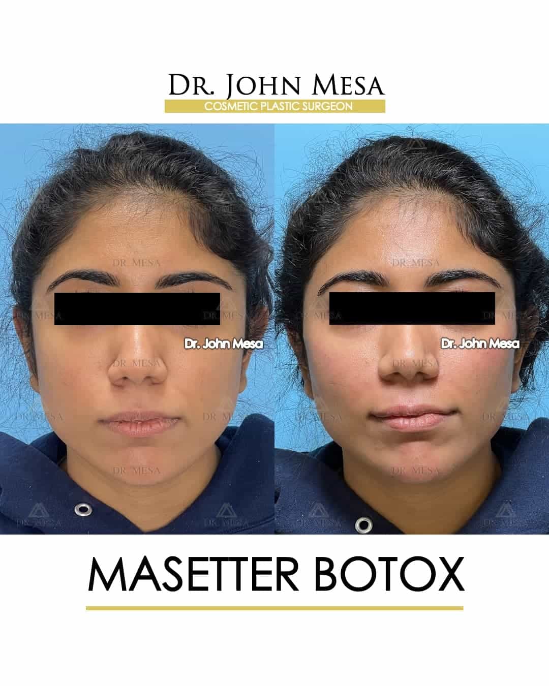 masseter botox dos and donts