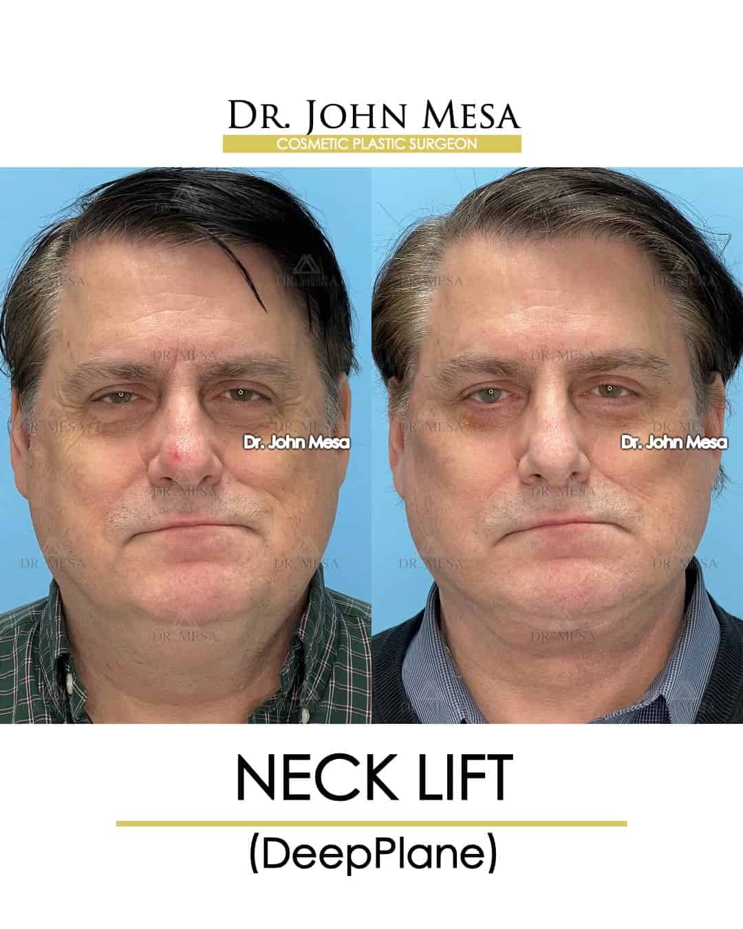 neck lift doctor for celebrities
