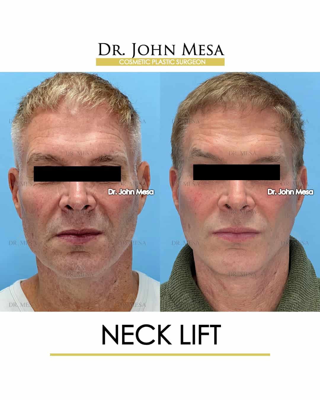 before and after photos minimally invasive neck lift for men