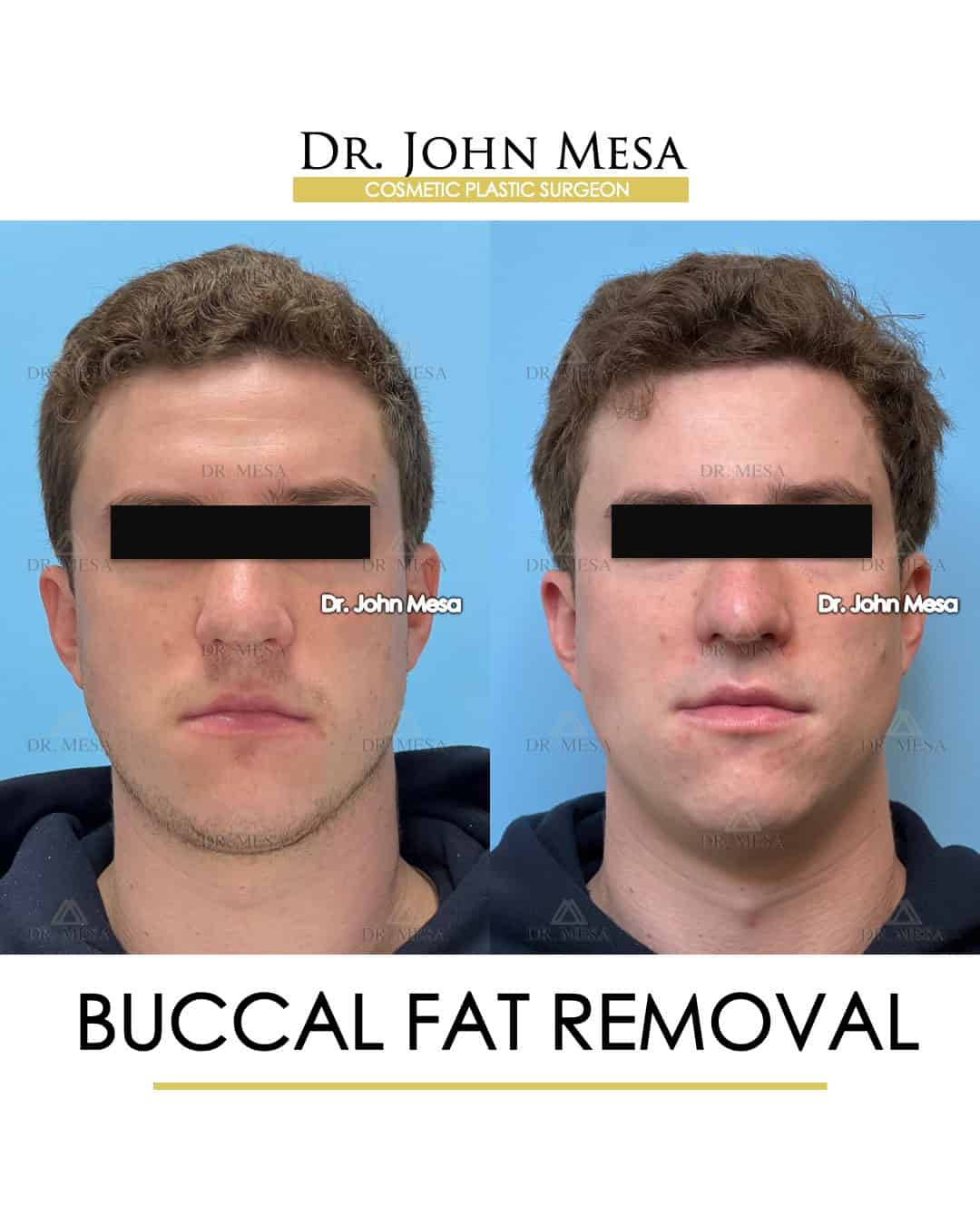buccal fat removal celebrities before after treatment photos