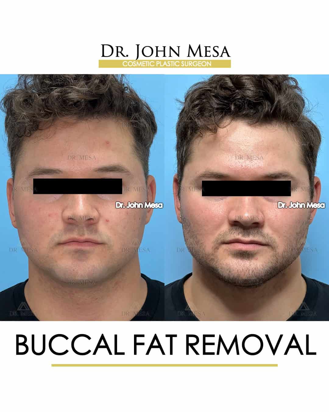 buccal fat removal celebrities