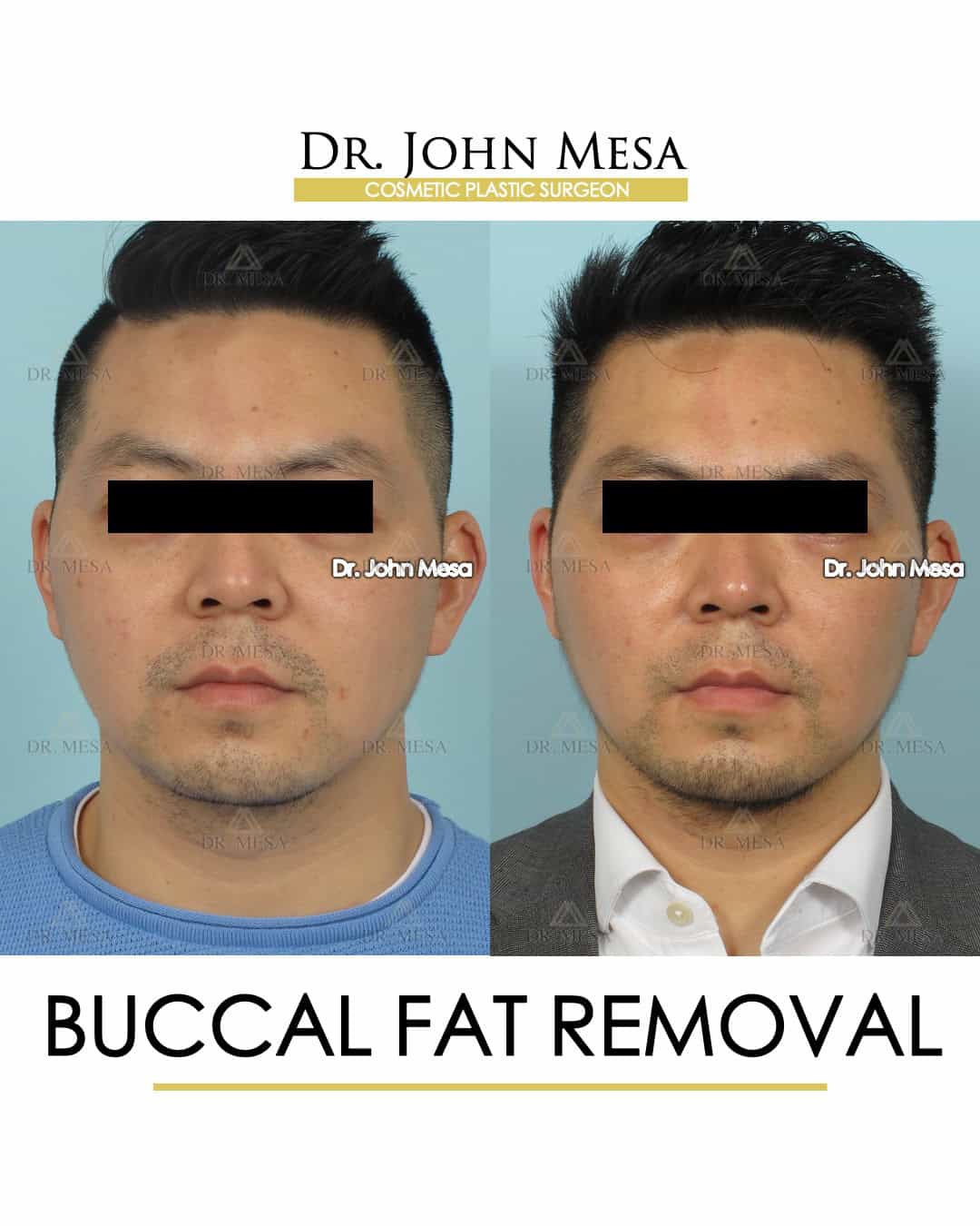 buccal fat removal celebs before and after recovery
