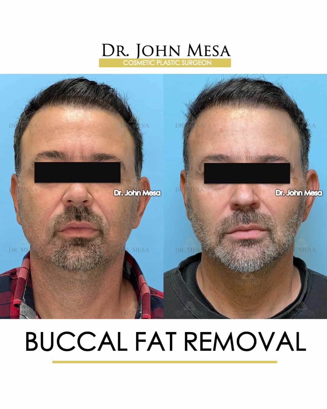 buccal fat removal before and after cheeks in men