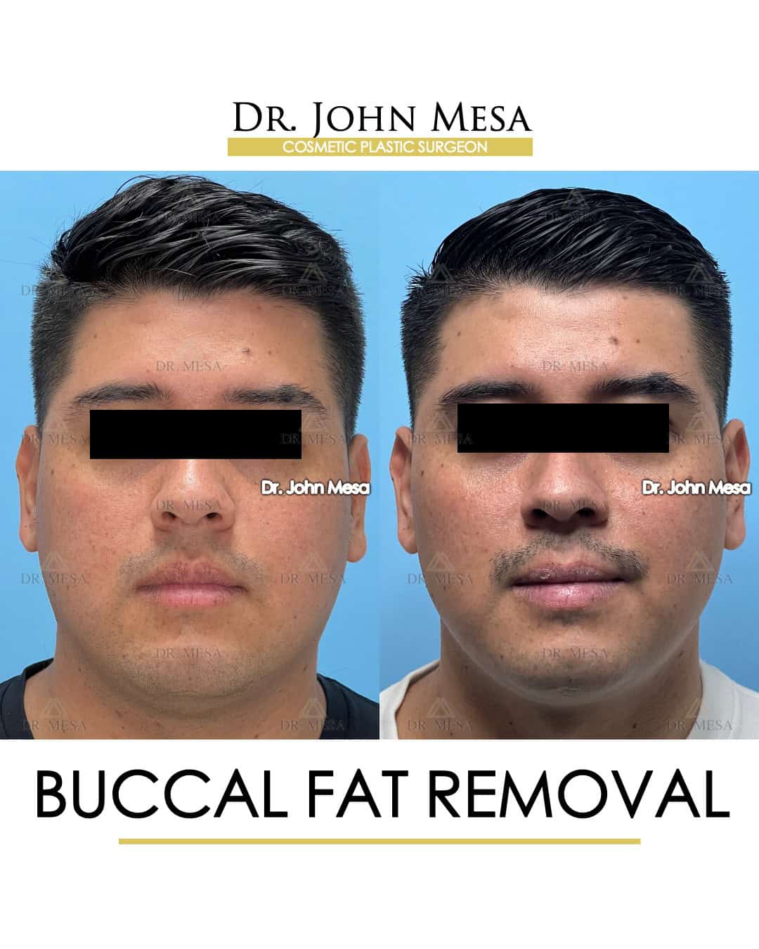 buccal fat removal cost of surgery in new york