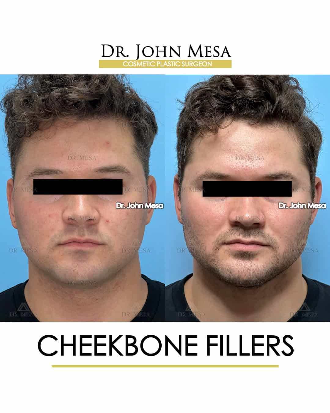 cheek plastic surgery for men