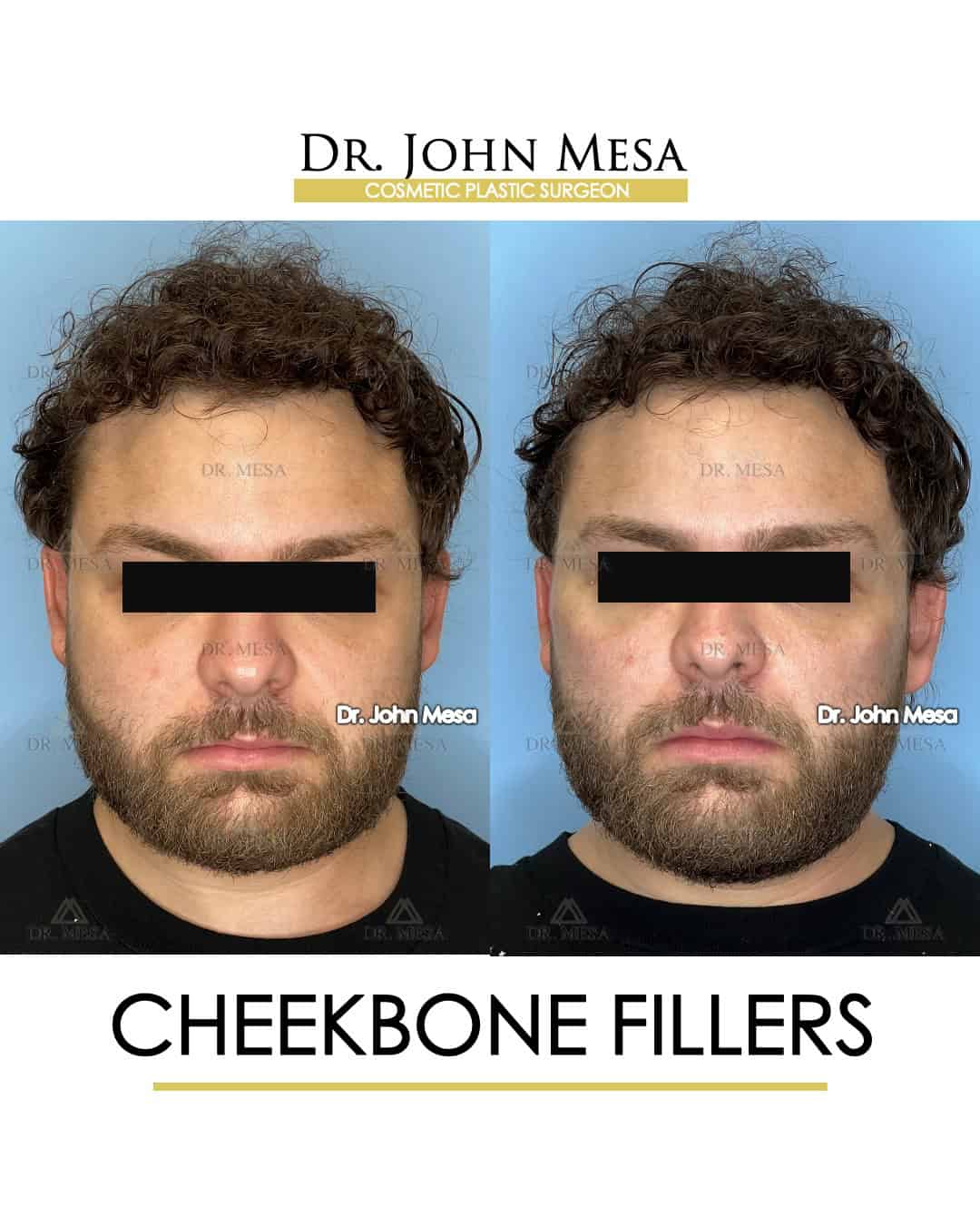 cheekbone augmentation before and after for men