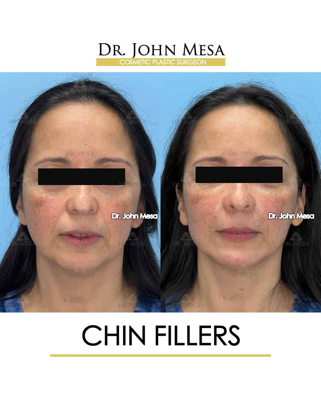chin fillers before and after images
