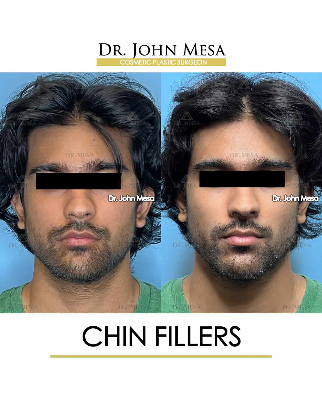 trusted doctor for chin fillers