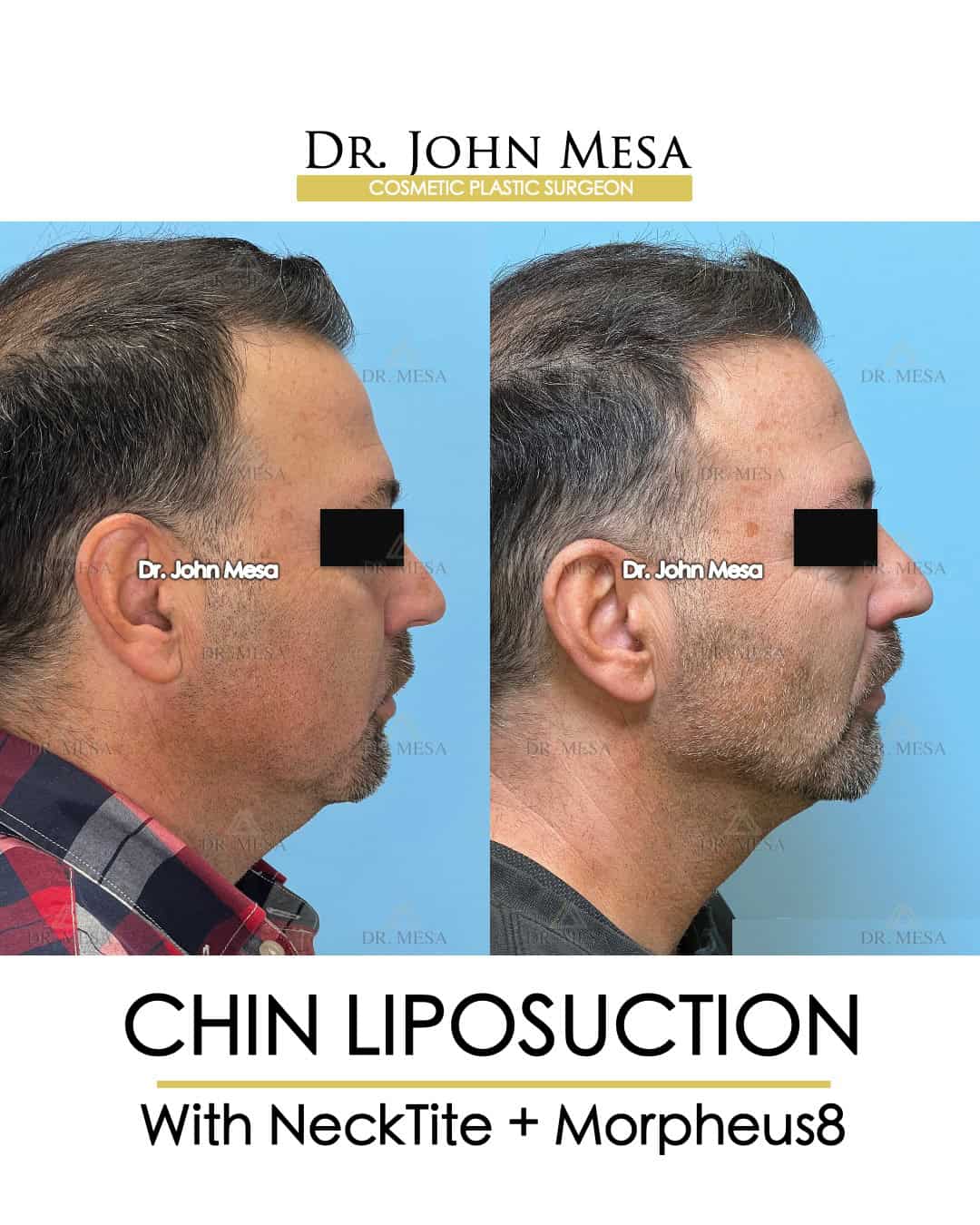 best chin liposuction in new york