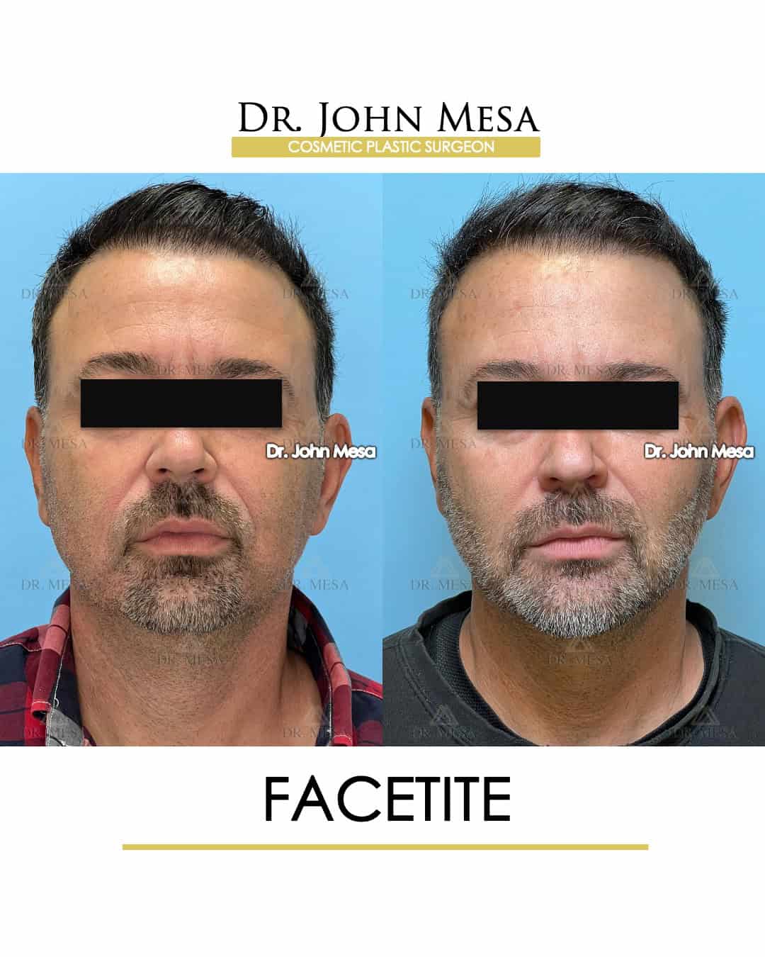 what is facetite surgery for men