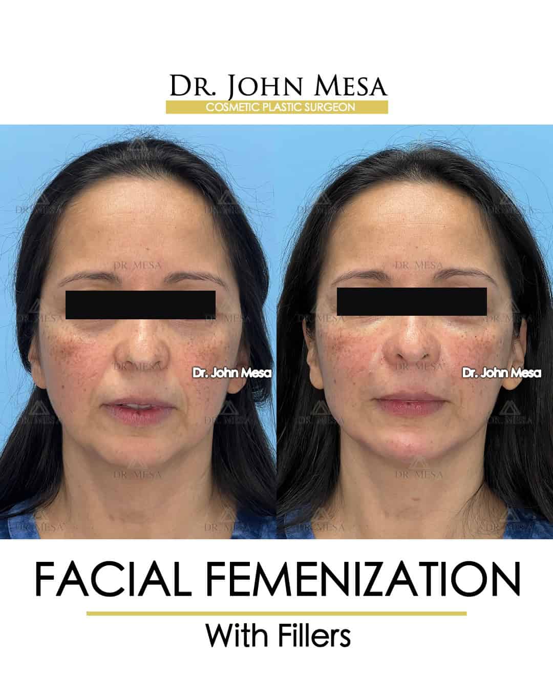 fillers for women before and after surgery photos