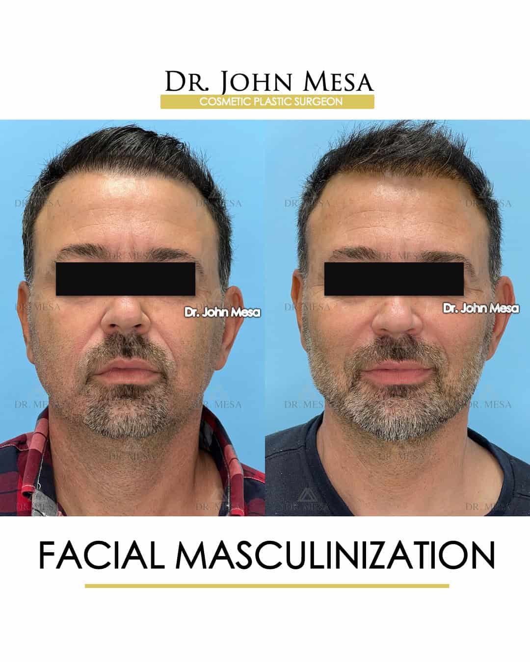 facial masculinization before and after surgery photo results