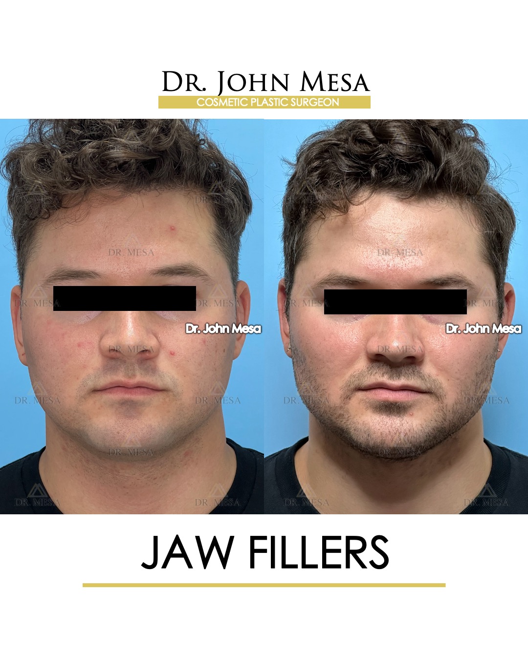 sample male celebrity jaw fillers before and after