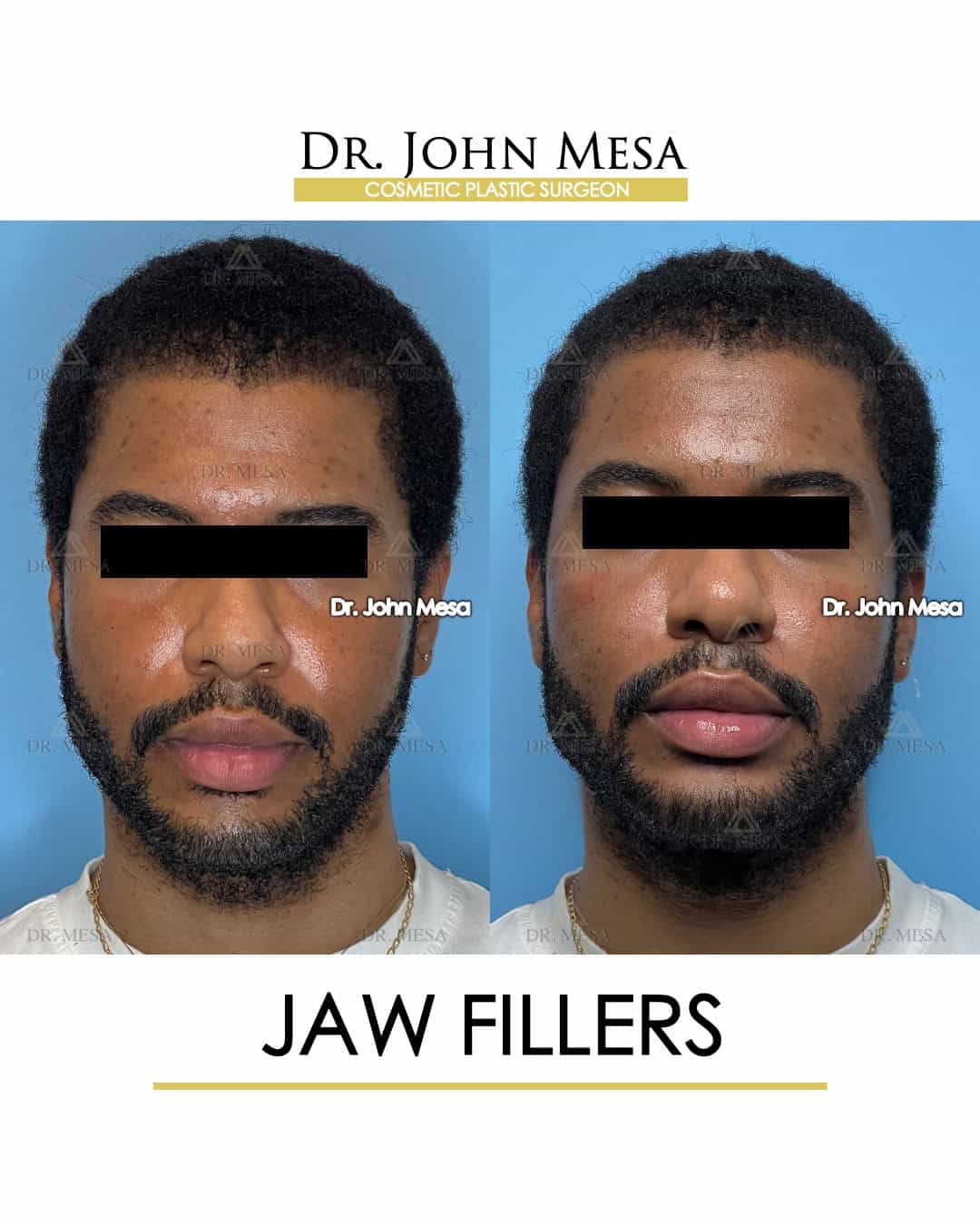how expensive are jaw fillers
