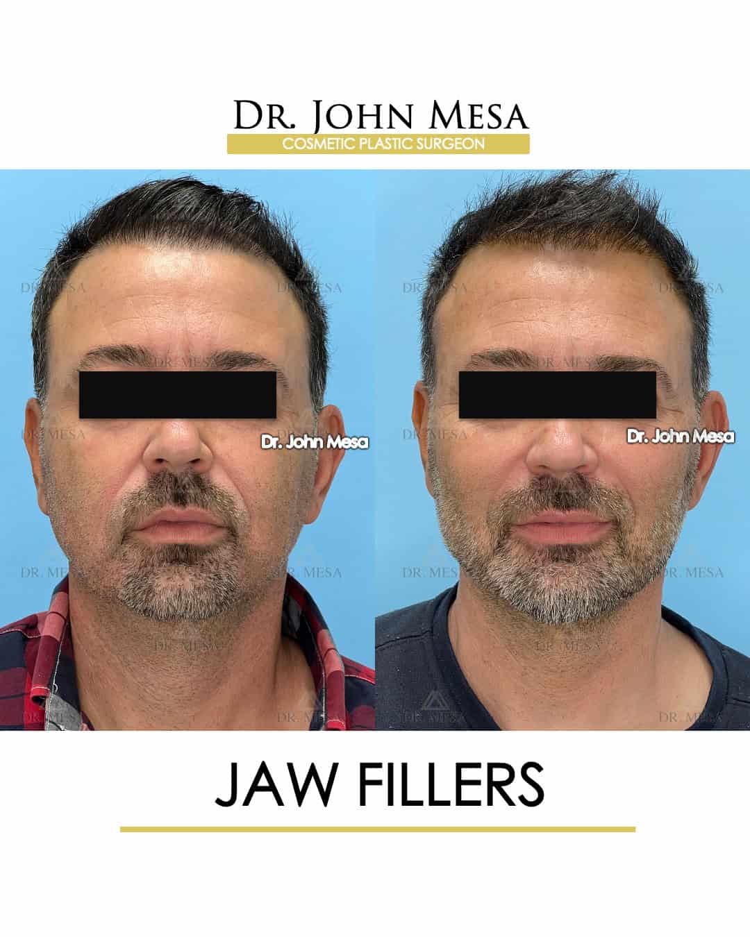 what do jaw fillers do for men