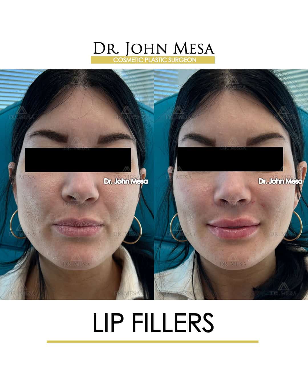 lip-fillers-miami