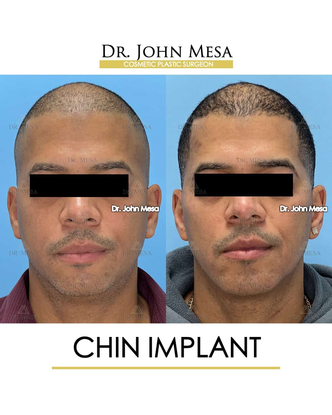 types of chin implants for men