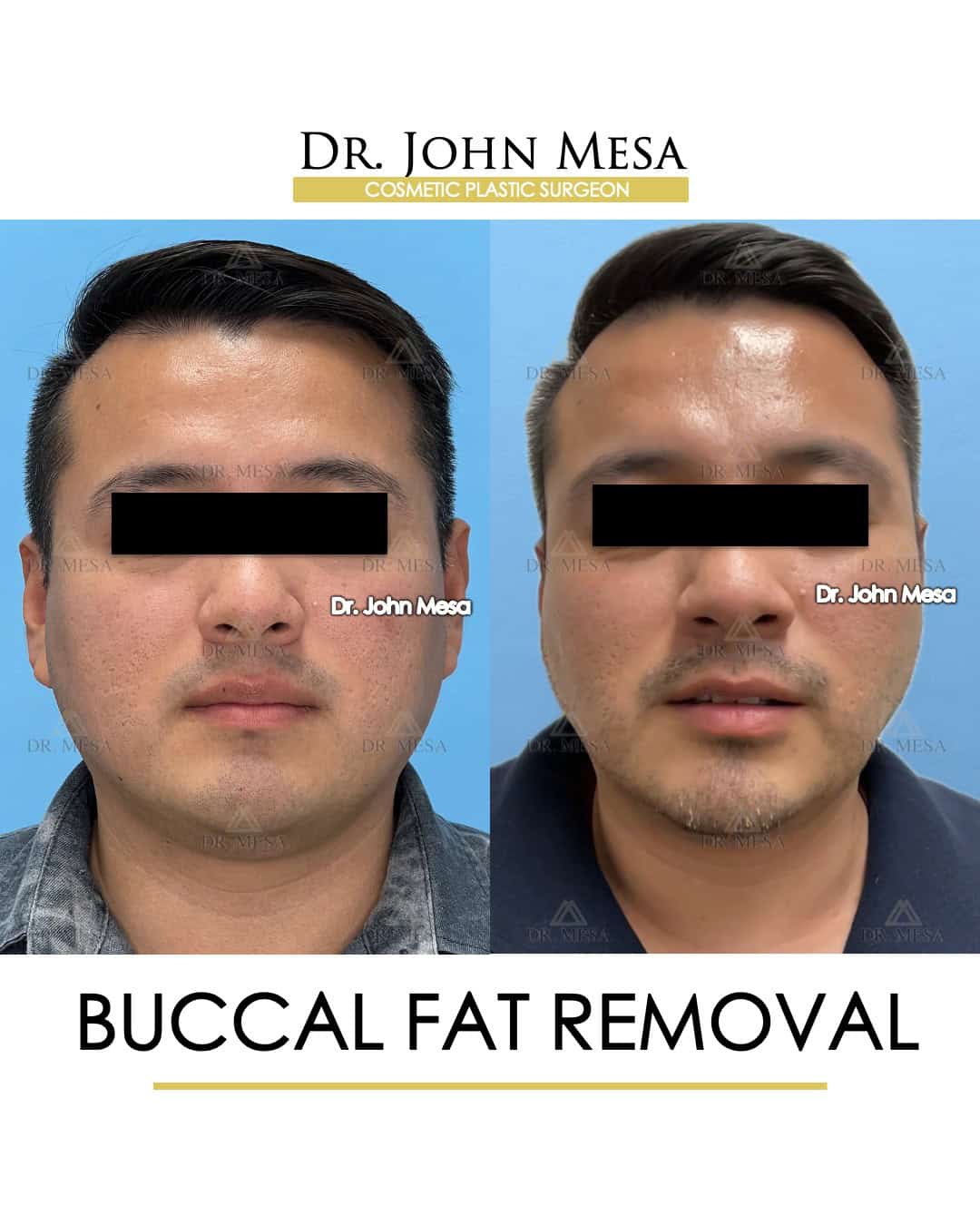 buccal fat removal celebrities reddit sample photos