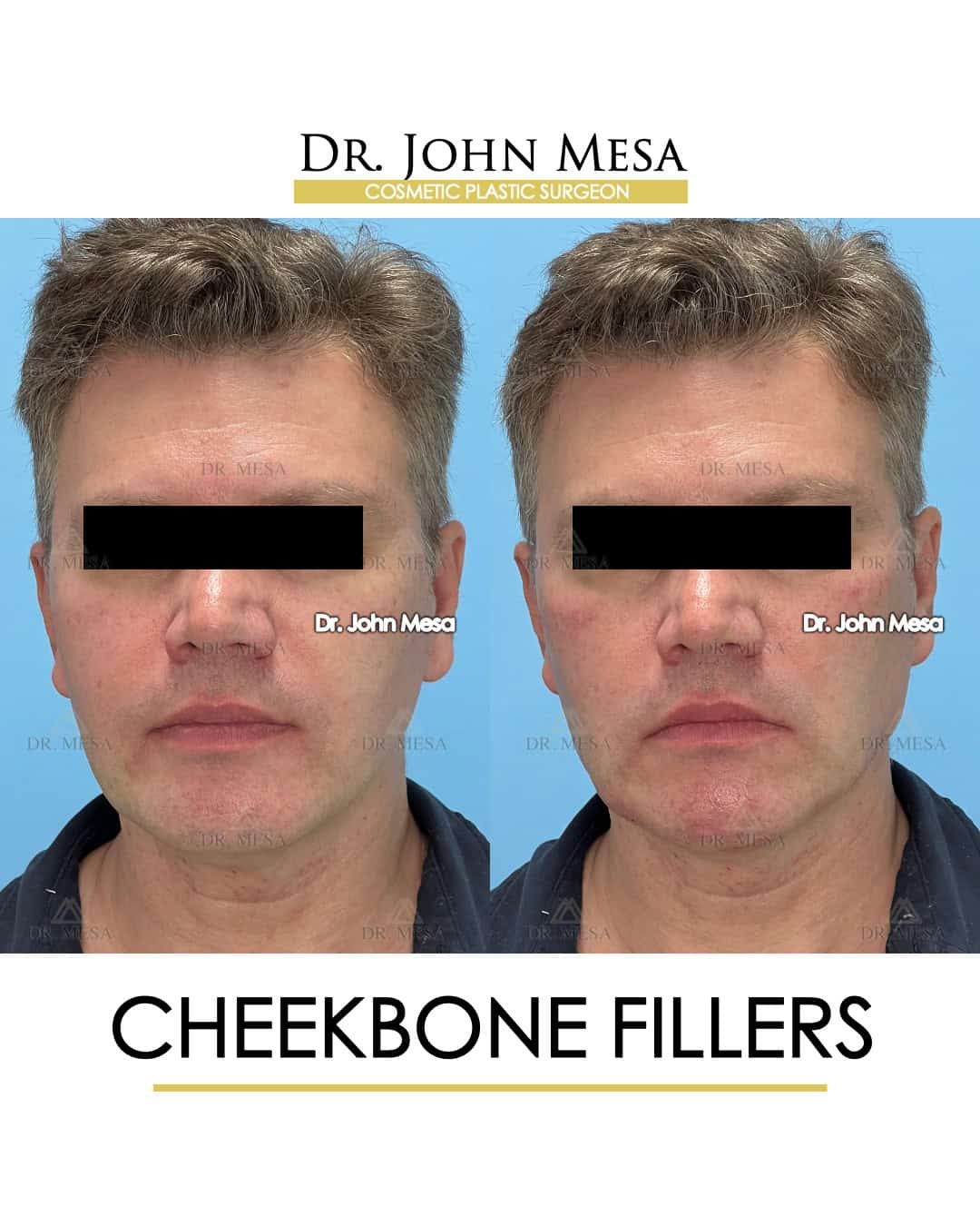 how much is cheekbone fillers?