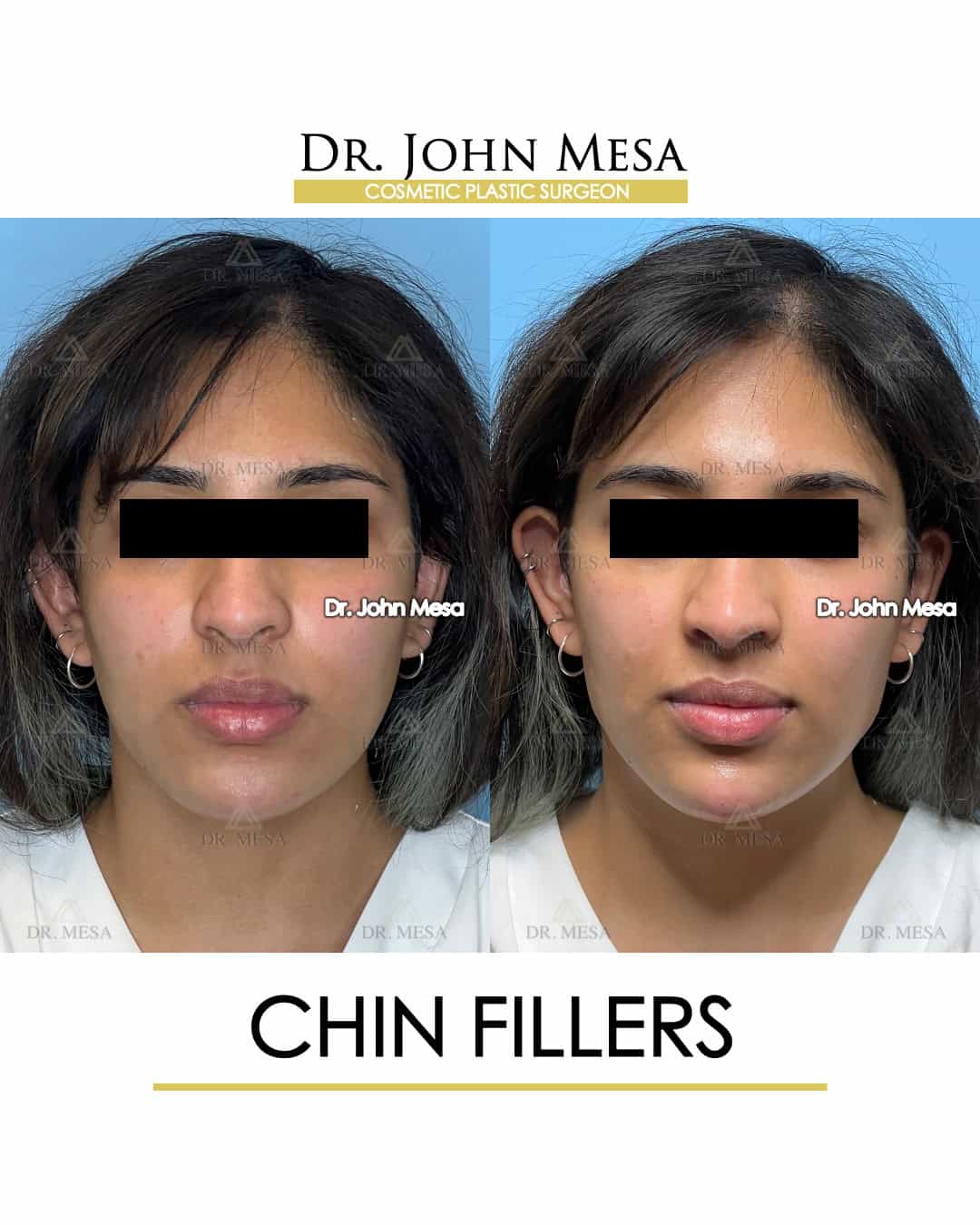 cost of chin fillers