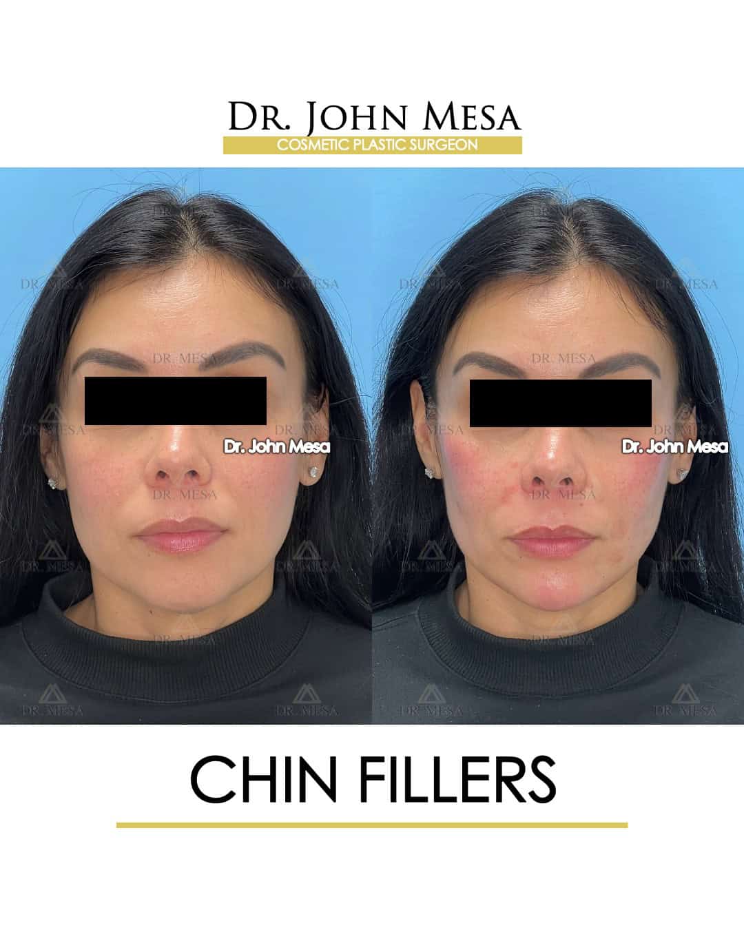 chin-fillers-before-and-after-women
