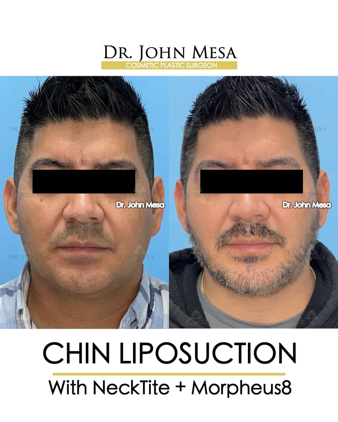 where to have chin liposuction for men