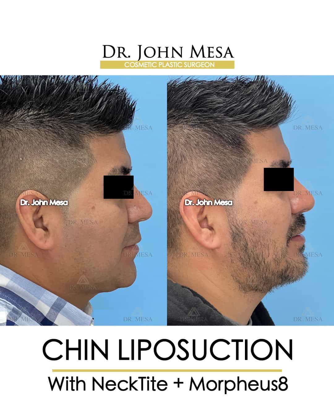 how effective is chin liposuction for men
