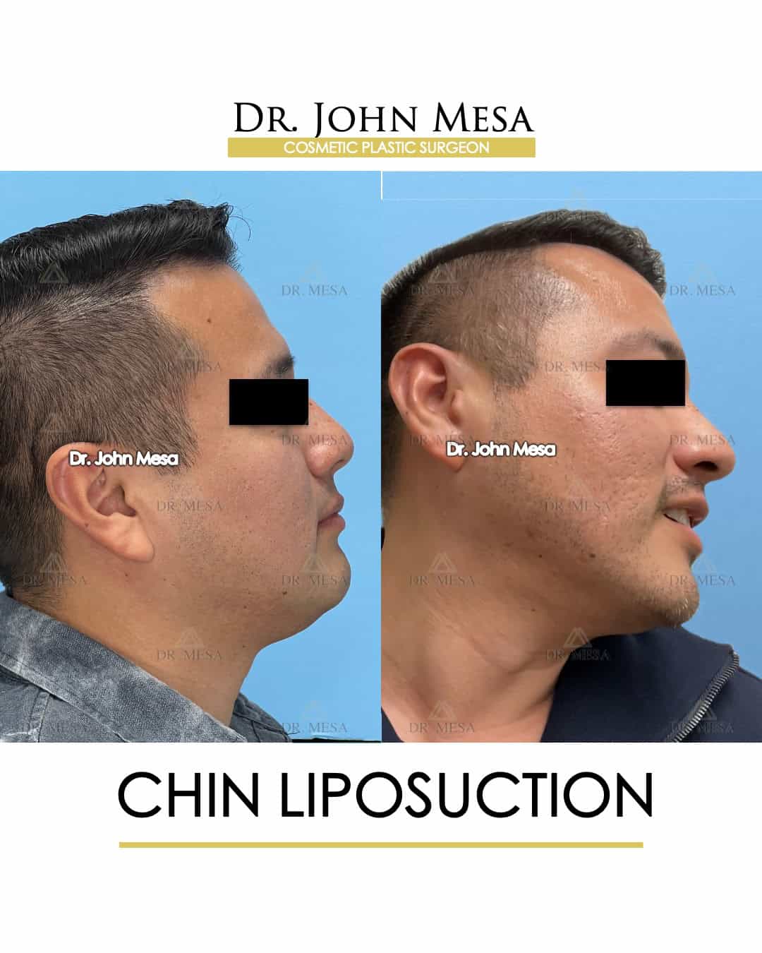 chin liposuction scar before and after