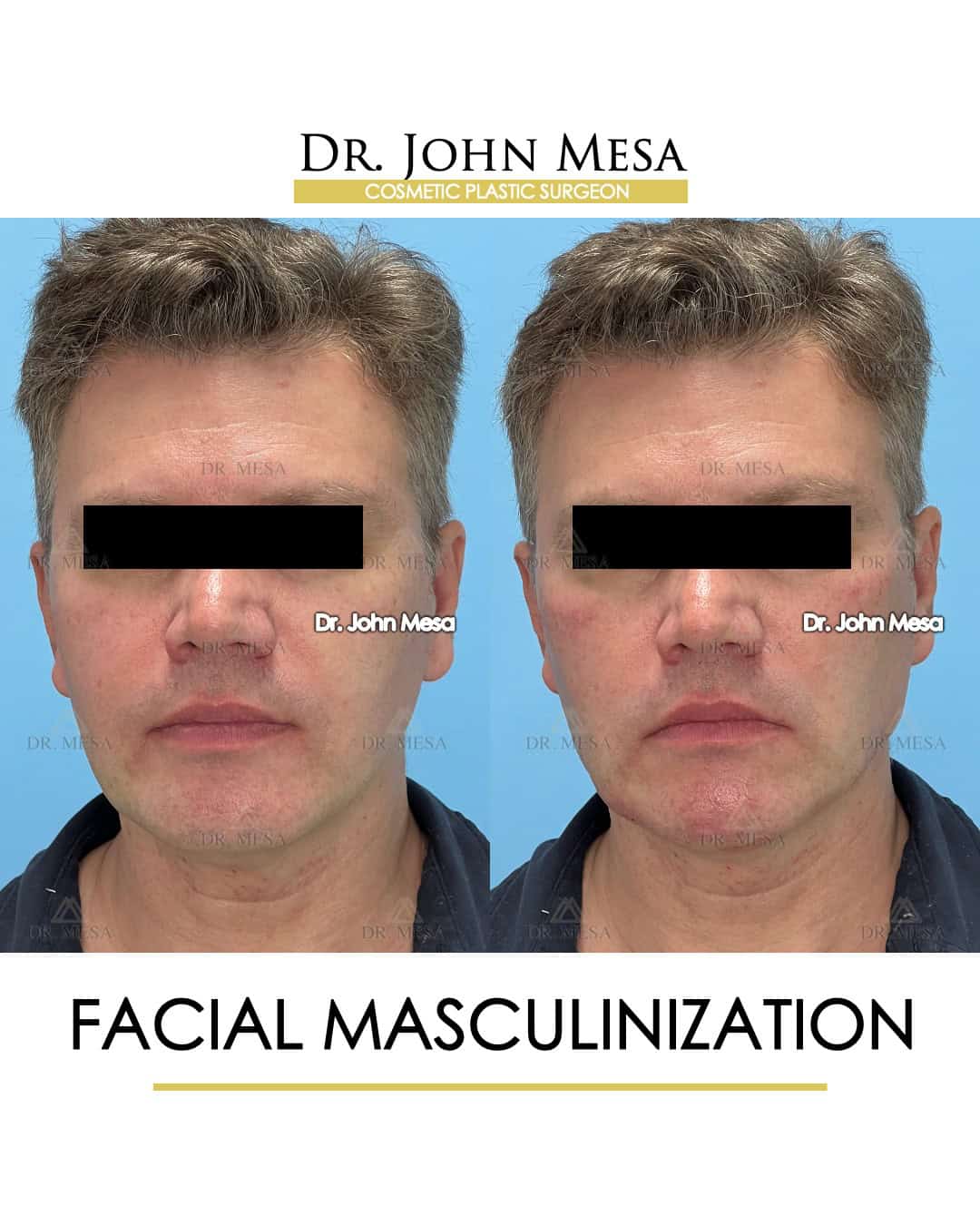facial masculinization surgery before and after