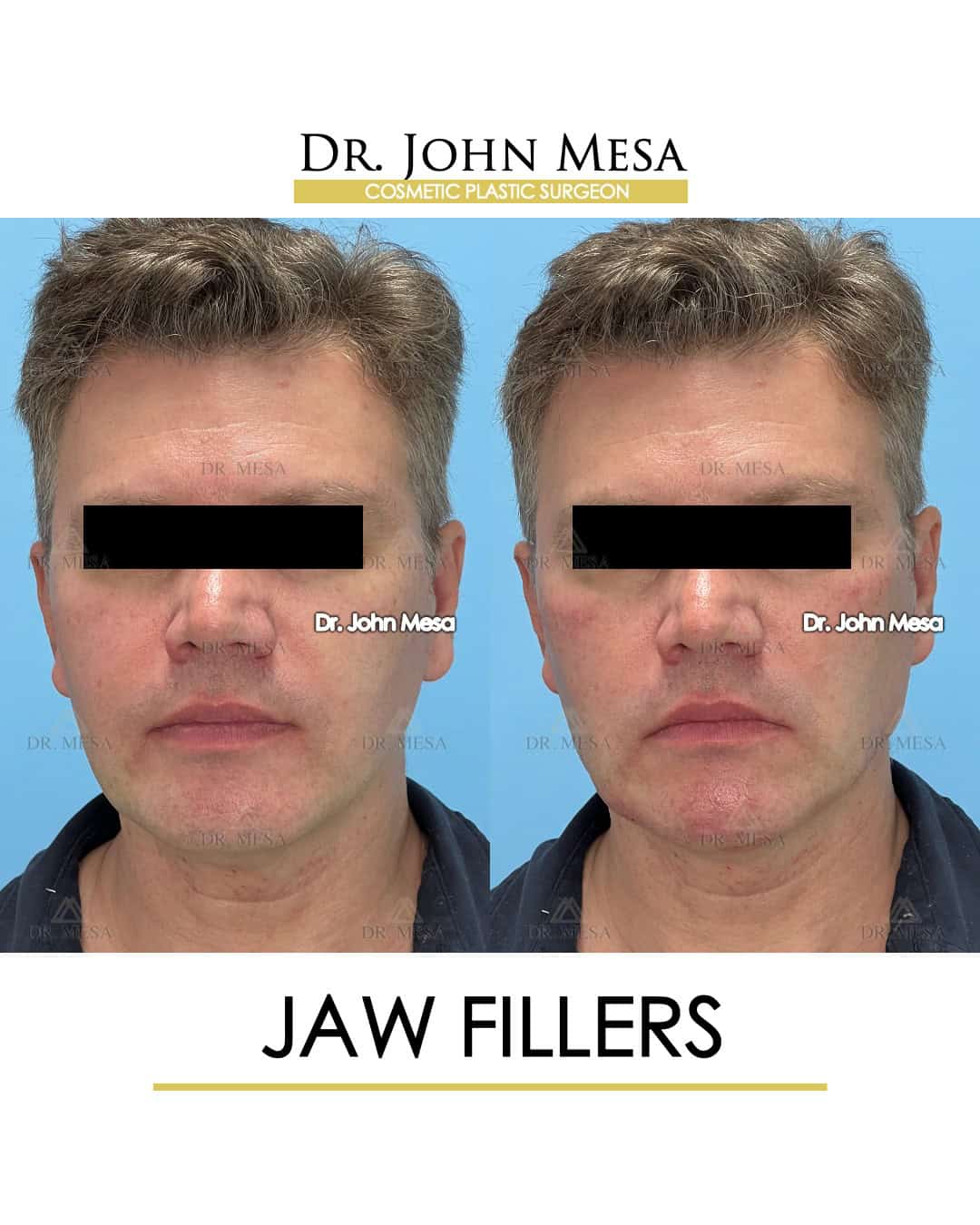 what do jaw fillers look like after surgery