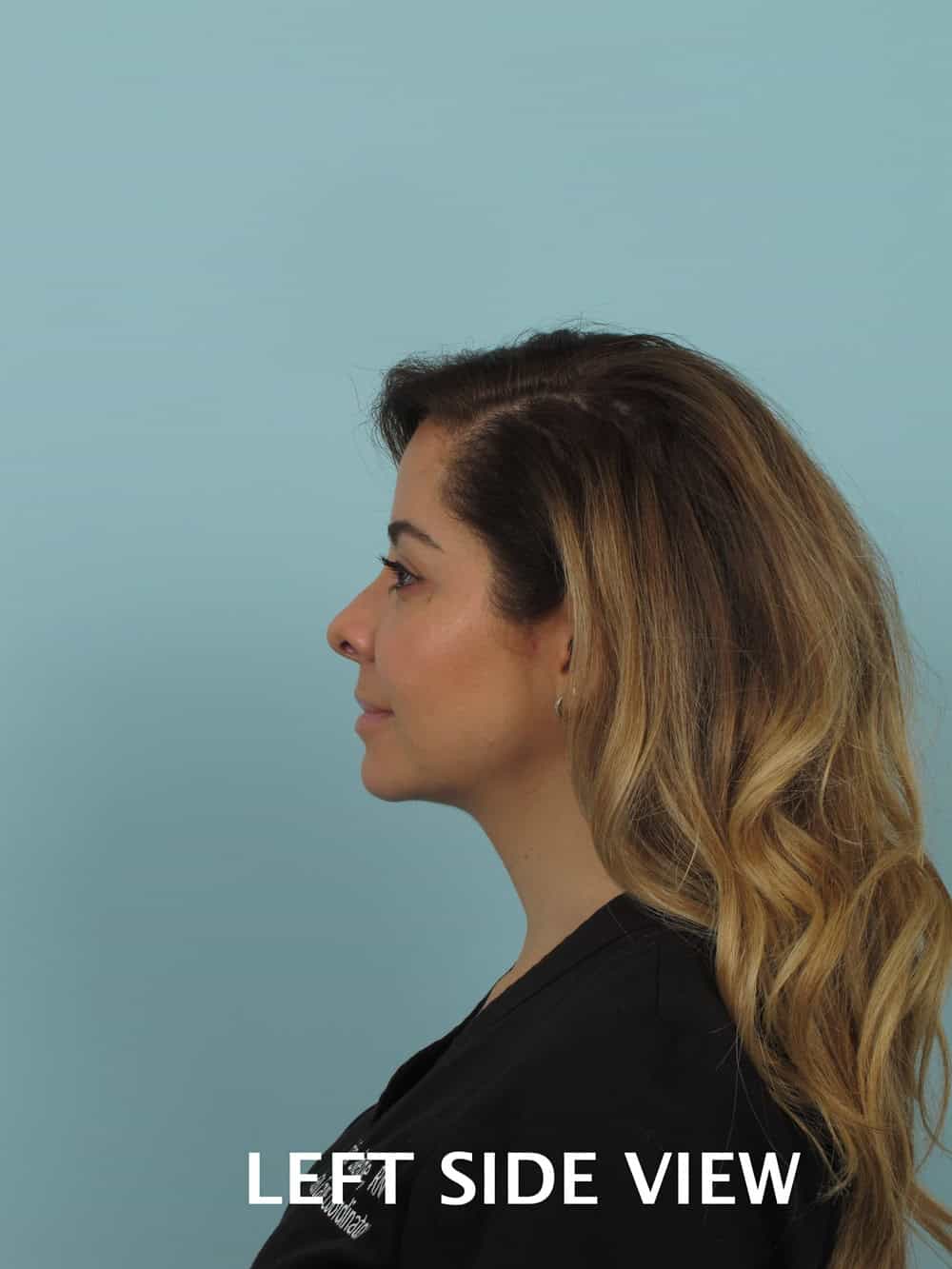 bucal fat removal before and after