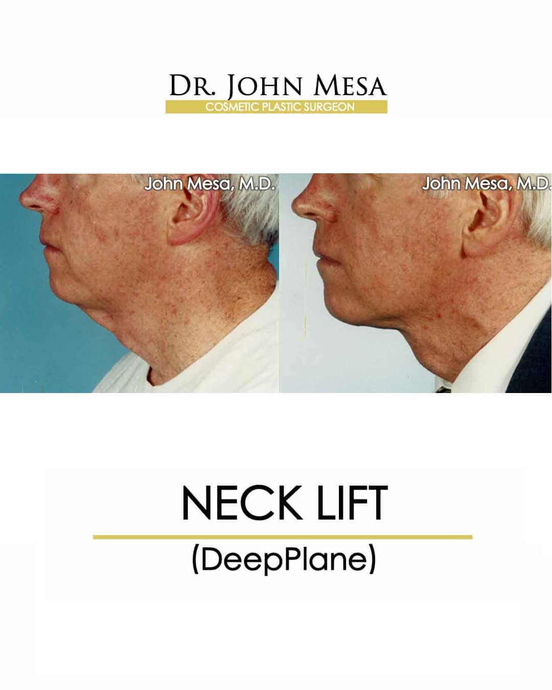 Neck Lift Before and After Men