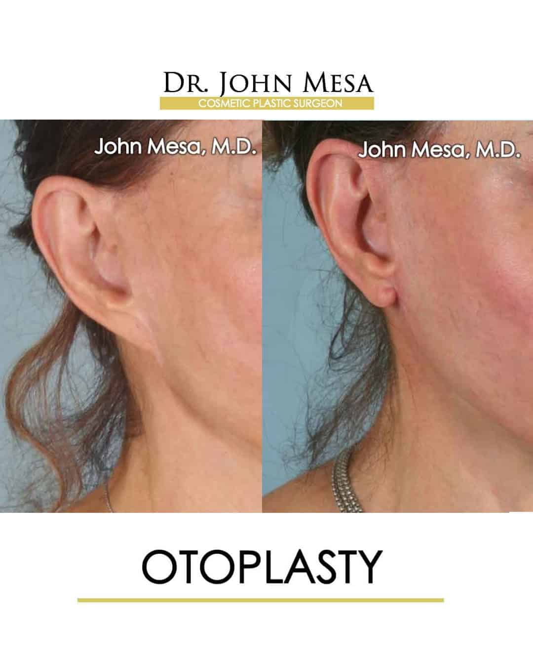 Otoplasty Doctor NYC
