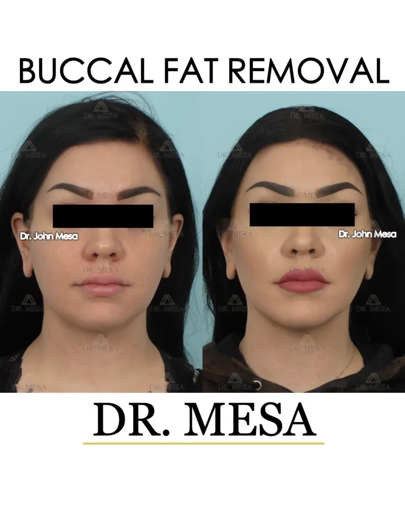 Female patient before and after getting Buccal Fat Removal in NYC with Dr. Mesa